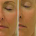 hydrafacial-btl-gallery-03.jpg